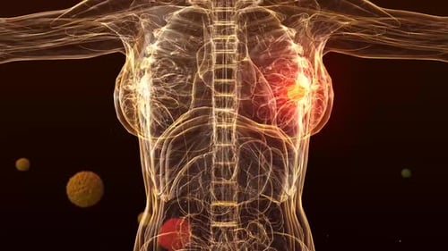 Stage 0 Breast Cancer 3d medical