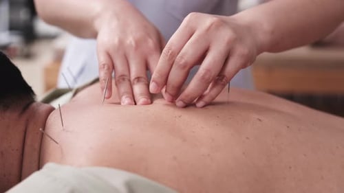 Plan rapproché d'une procédure d'acupuncture pour soulager les maux de dos.