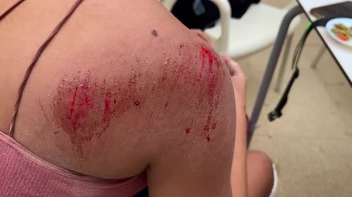 Cleaning a Scraped Shoulder Wound