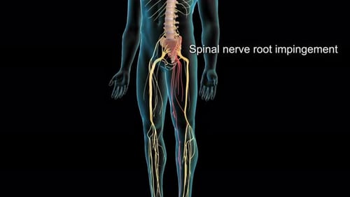 Spinal Nerve Root Impingement Medical 3D Animation