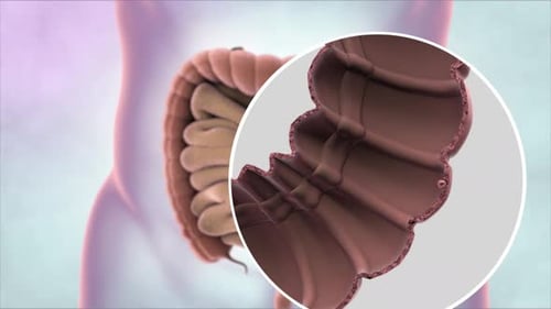 3D Medical Animation of Intestine Polyp Growth and Development