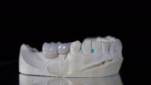 Dental Bridge on Rotating Plaster Tooth Model