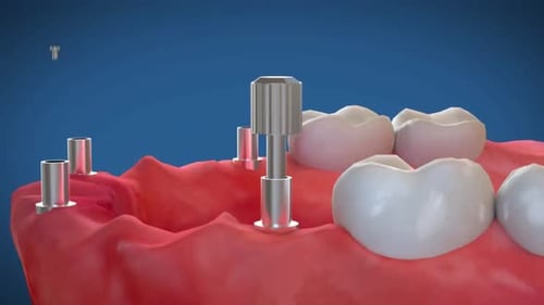 3D Dental Implant Installation Process Animation