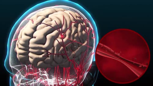 3D Animation: Brain Blood Flow and Vessel Blockage