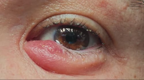 Inflamed Eye of Man with Stye Infection