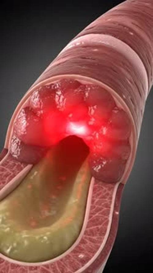 Inflamed Artery with Plaque Buildup 3D Animation