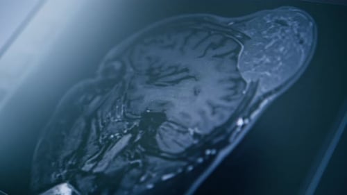 Computertomographie, Gehirn, 3D-Rendering, Bild auf dem Bildschirm, Gehirnentzündung, Krankheit in der Klinik