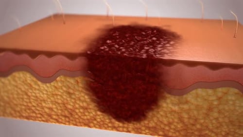 Skin Cross Section with Expanding Lesion Medical Animation