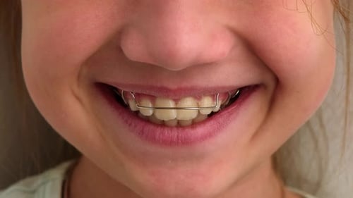 Child Girl Mouth with Orthodontic Plate Close Up