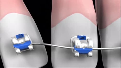 Primer plano de dientes con aparatos ortopédicos y alambres