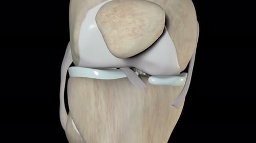 Anatomical animation showing human knee joint ligament injury and inflammation