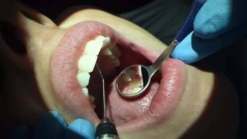 Dental Care Extreme Close Up Macro Video Dentist Treat Patient Teeth Orthodontist Works with