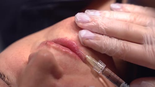 Lip Augmentation Procedure with Injection