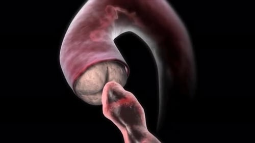 Animated Blood Flow Through Aortic Valve and Infection