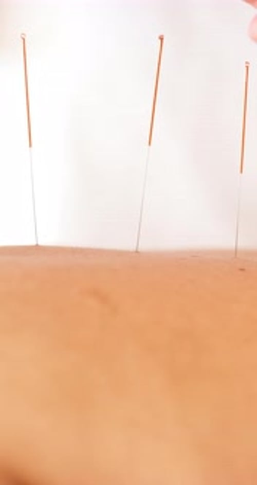 Akupunktur, Rücken und Hände eines Therapeuten mit einem Patienten in der Klinik für Muskelverspannungen