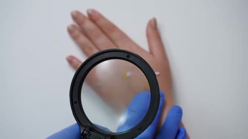 Top View Loupe with Doctor Hand in Gloves Examining Monkey Pox Rash on Female Palm