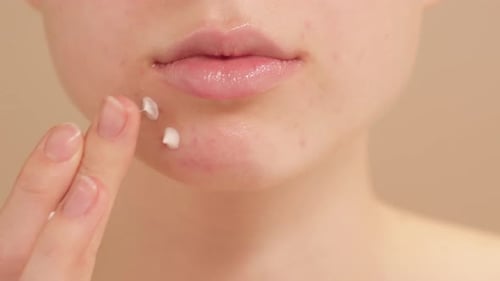 Beautiful Young Woman Gently Applying Acne Spot Cream for Clear Radiant Skin