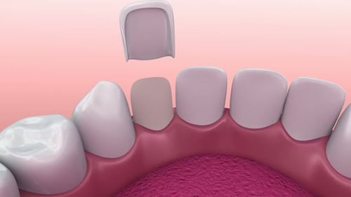 3D Animation of Dental Veneer Placement and Bonding