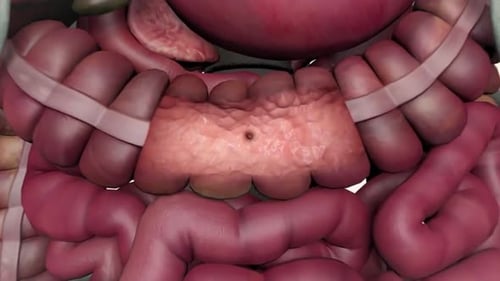 Pancreatic Stone Formation within Human Abdomen Medical Animation