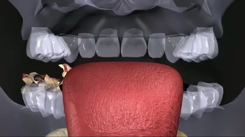 3D Animated Medical Illustration of Tooth Decay Removal