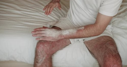 Sensitive Skin Due to Sun Exposure Apply Sunscreen