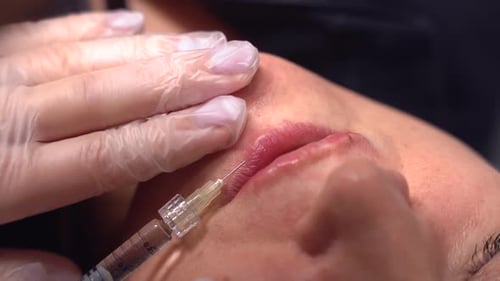Lip Filler Injections for Cosmetic Enhancement Close Up