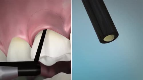 Dental surgery procedure showing gum sculpting with laser
