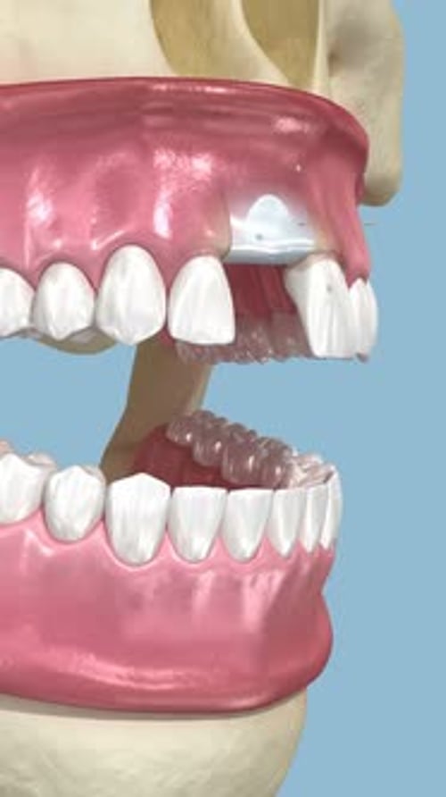 Injerto óseo, aumento, preservación del alveolo, implantación dental