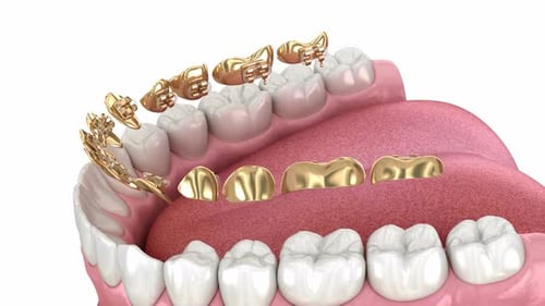 3D Animation of Lingual Braces Application and Removal