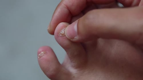 Toe nail wear, Carving nail trauma with hand, close up 4K shot.
