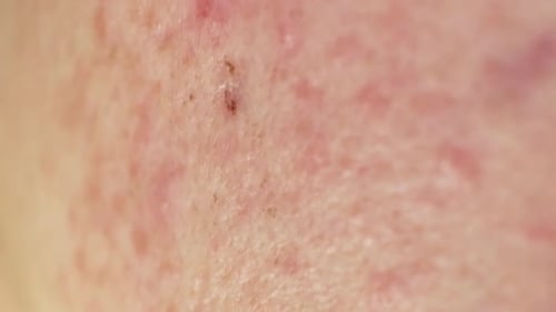 Macro Shot of Irritated Facial Skin with Redness and Acne Highlights Common Skin Problems and the
