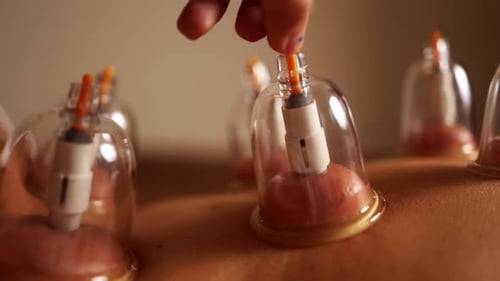 Chinese cupping therapy at spa. Vacuum suction treatment for pain relief