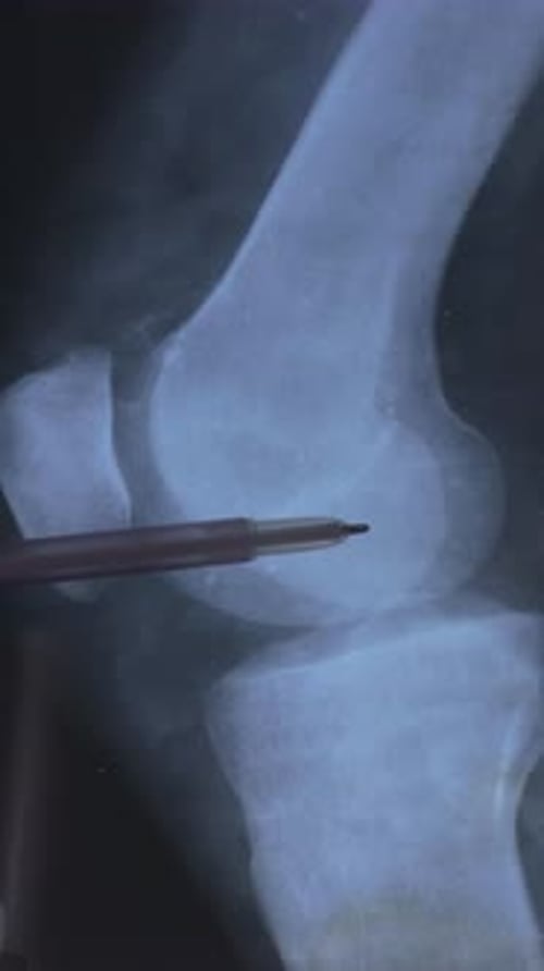 X-Ray of Knee Joint Being Shown