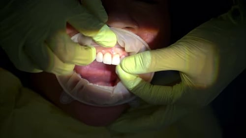 Slow motion of a dentist placing composite veneers on a patient's tooth wearing green gloves. Vertic