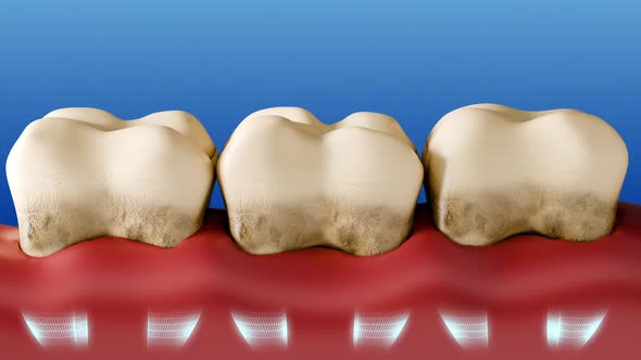 3D Animation of Teeth Cleaning and Plaque Removal, Backgrounds Motion ...