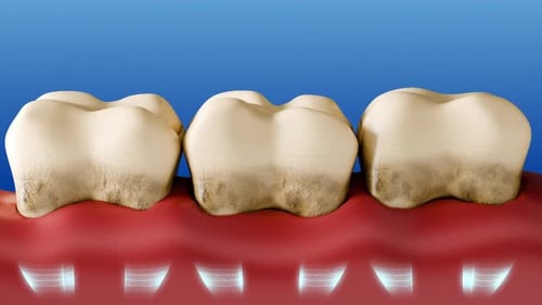 Healthy Teeth Removing Calculus And Plaque Tartar Cleaning Oral Hygiene 3D Animation