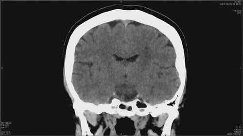 Animated Human Head CT Scan Coronal Slices Medical Background