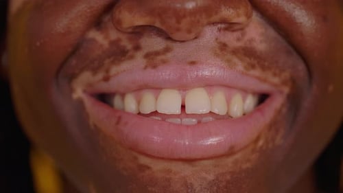 Close Up View of Smiling Young Woman Mouth with Vitiligo