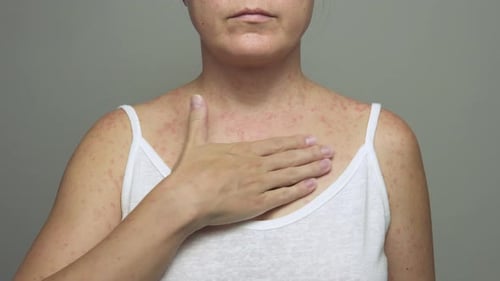 A woman with a red, spotty rash caused by measles.