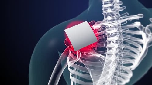 Medical Visualization of Shoulder Joint Inflammation
