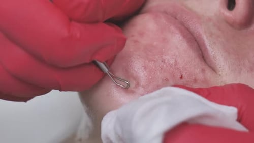 Akne von einem Mädchen mit problematischer Haut im Salon mithilfe einer Schlaufe auspressen