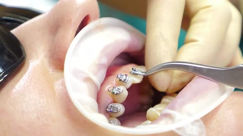 Adult Having Braces Adjusted in Dental Clinic