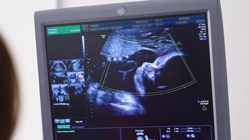 Sonogram of Fetus Displayed on Monitor