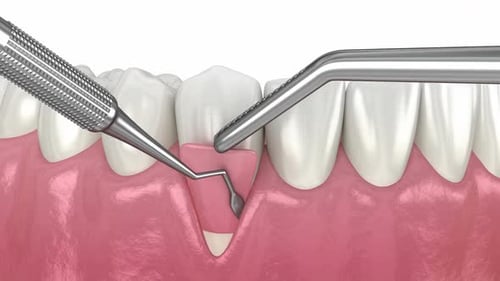 Gum Recession: Soft tissue graft surgery
