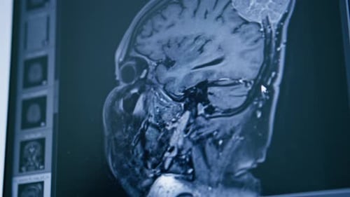computer tomography brain 3d rendering image on screen brain inflammation disease in clinic
