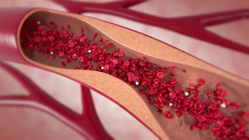 Plaque Formation in Human Artery: Obstructed Blood Flow Animation