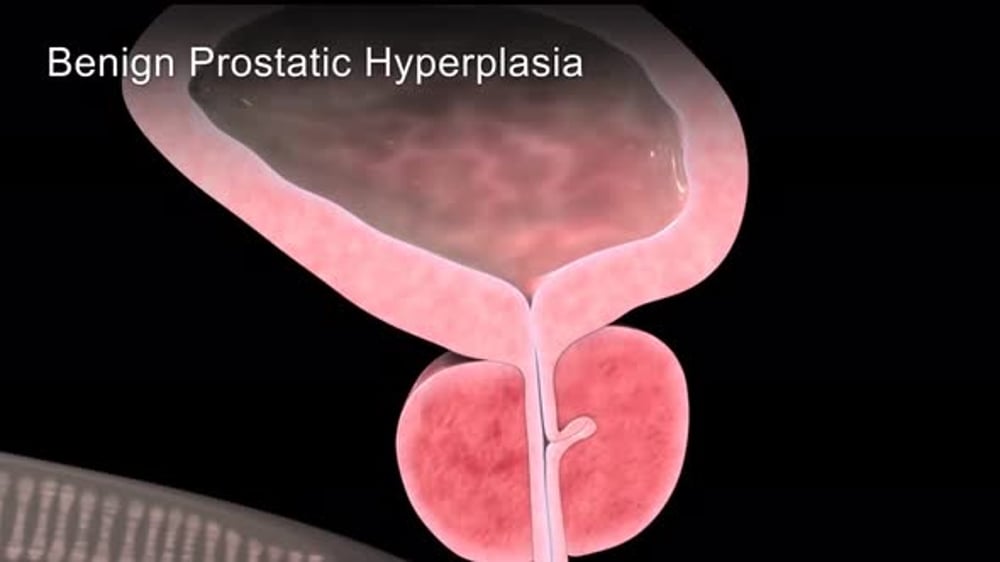 Benign Prostatic Hyperplasia Medical Animation, Backgrounds Motion ...