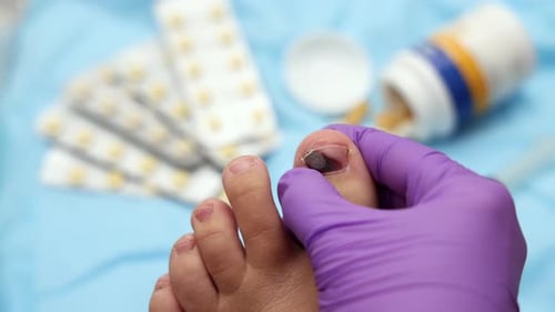Injured Toe With Missing Nail Being Examined
