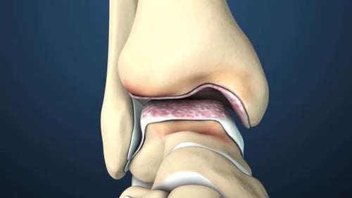 Ankle Articular Cartilage Degeneration and Damage