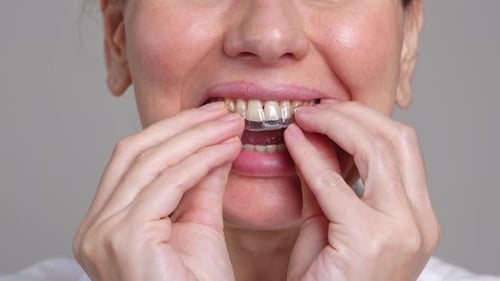 Nahaufnahme Frau mittleren Alters trägt transparente Schienen am Oberkiefer Zahnpflege und Zahnheilkunde